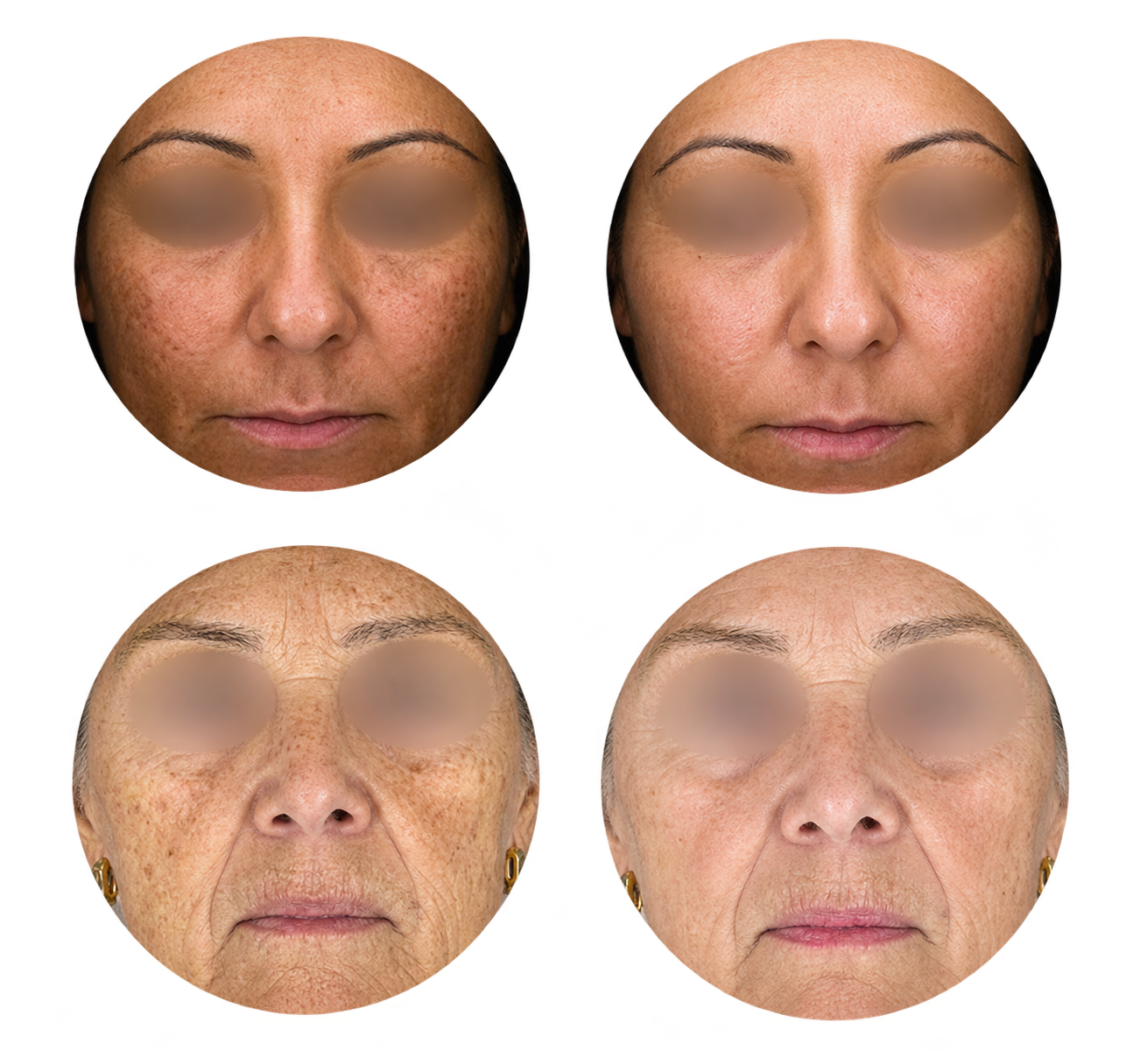 XERF™ antes e depois